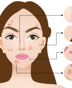 Volledige samenvatting acne en eczeem huidtherapie leerjaar 1