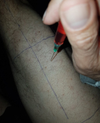 Reflectieverslag Musculaire B12 injectie